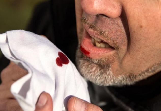 陈皮|患肺结节的人越来越多多吃2黄,或有助于结节消散,保护肺部