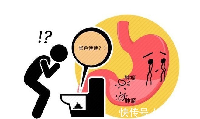 腹部疼痛|是胃癌,还是胃炎,傻傻分不清!医生介绍:看好几点,别再混淆