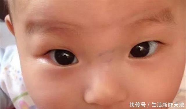 发育不良|宝宝鼻梁上有“青筋”,体质差脾气也大别因误会忽略真正的诱因!