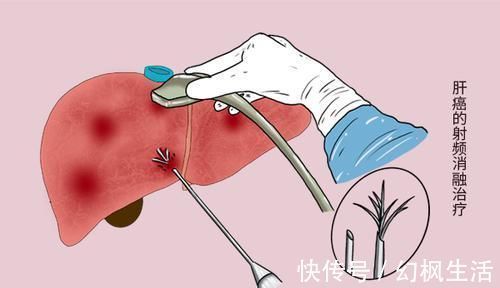 两者|肿瘤不等于癌症,两者到底有什么区别看完就安心了