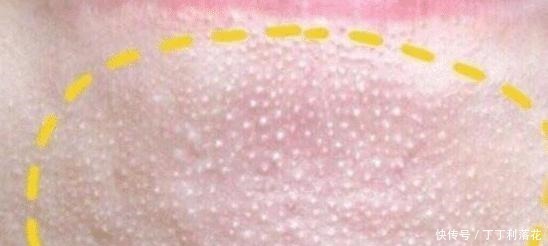 嘴角的下巴总是有白色的痘痘,且还连成一片,是螨虫吗