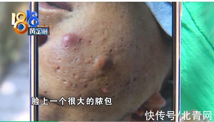 管理机构|小伙脸上长脓包“痘院士”强调“没来”