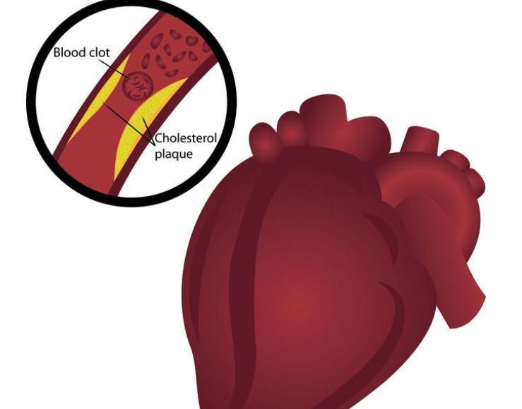 斑块|冠心病,是由什么原因引起来的?听听医生怎么说