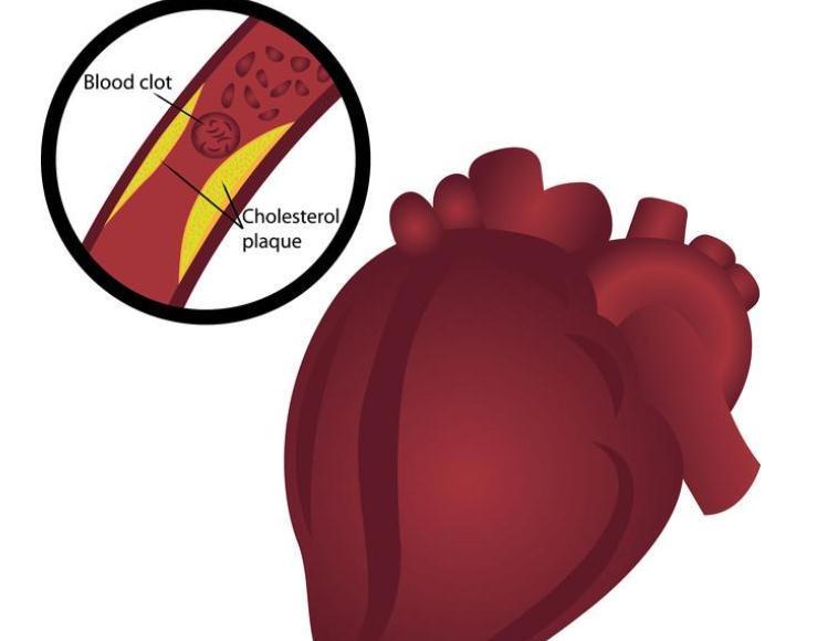 斑块|冠心病，是由什么原因引起来的？听听医生怎么说