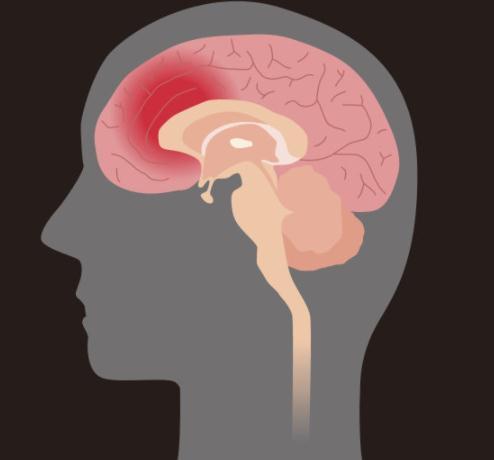 运动障碍|被称为“最快杀手”的脑出血，最怕3件事，高血压患者赶紧收藏