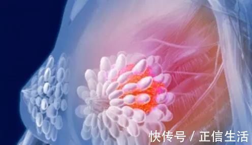 乳腺癌|钙化是癌变的信号和哪些癌症息息相关呢