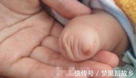 先天|孕检很正常,却生下畸形儿,医生这5种情况四维彩超也看不出