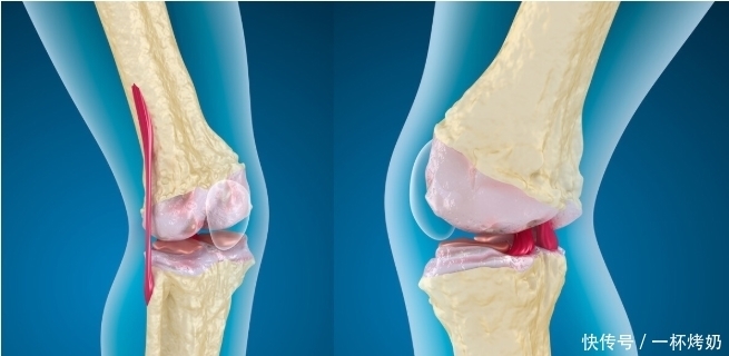 骨质疏松,别等50岁才重视!牢记4个补钙妙方,离骨质疏松更远