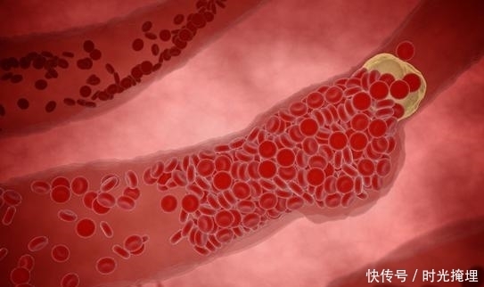 血稠药|农村发现“血稠药”,每天2口,血液不脏、血管畅通无阻,轻松!
