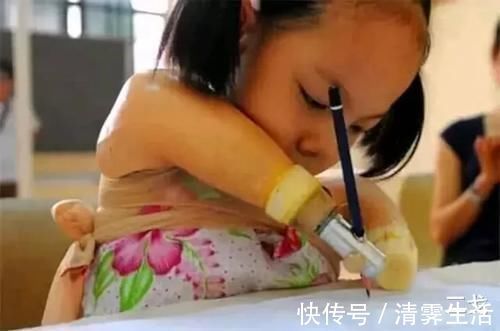 畸形|孕检发现娃是畸形,宝妈不顾劝阻坚持生下,如今将女儿养成公主