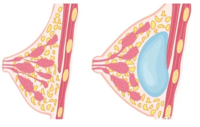隆胸 假体隆胸术后会影响喂奶？这是真的吗？