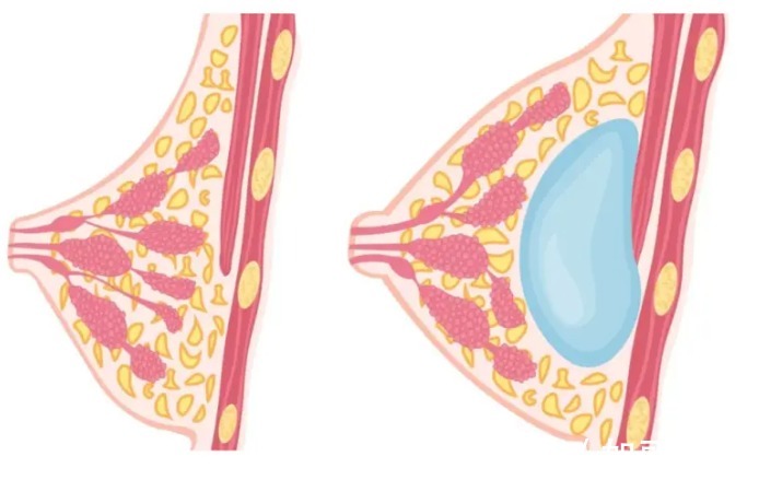 隆胸 假体隆胸术后会影响喂奶?这是真的吗?