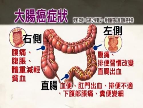 大便|痔疮和肠癌傻傻分不清，中年男子查出肠癌，大便早已“提醒”