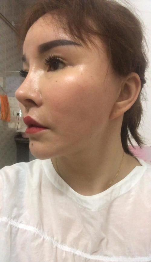 不到50岁就老成大妈？小拉皮术后6个月轻松实现逆生长！