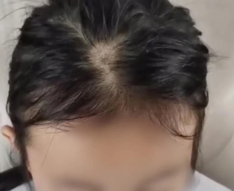 小女孩|6岁女孩突然“秃头”,奶奶以为是鬼剃头,医生怒斥无知