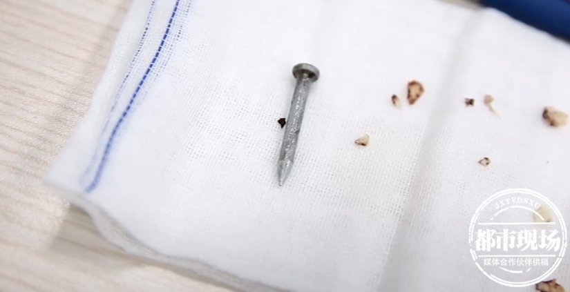 眉心|可怕!男子干活时,1个钉子突然射中眉心进入大脑