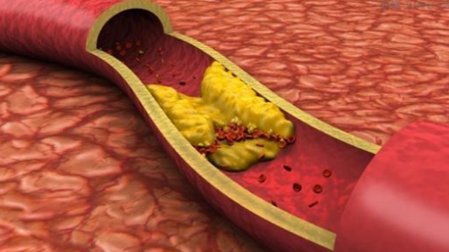 苦荞|阿司匹林的“同行”被找到,不仅防血栓,还能预防血管变硬变脆