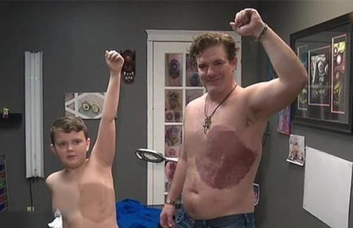 手术切除|小男孩因胎记感到自卑,爸爸一个做法获高赞,网友:最美“胎记”