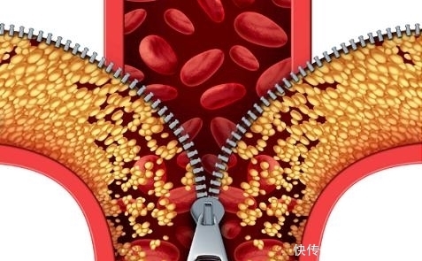 身体一旦出现这5个变化,说明脑血栓即将来临,切莫忽视!?