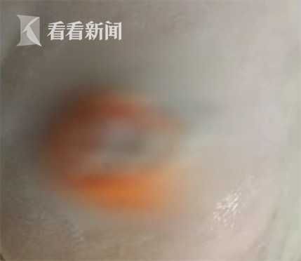 右脚跟|脚底一颗小“黑痣” 女子没在意差点丢了命！