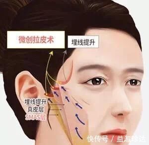 年纪|聊一聊除了拉皮手术,微创小切口提升怎么样?多大年纪适合做?