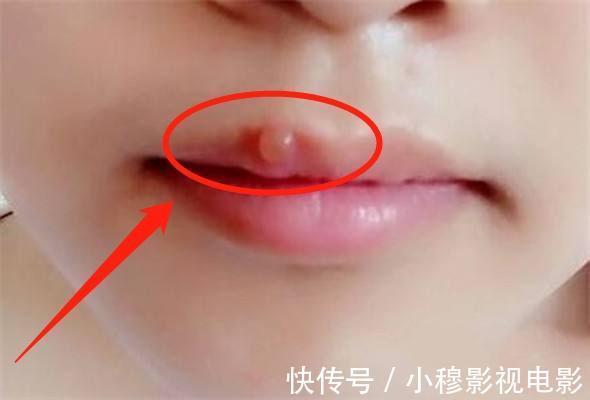 解毒|肝脏毒素增多了?嘴唇会有3个现象,若你1个都无,恭喜肝脏很干净