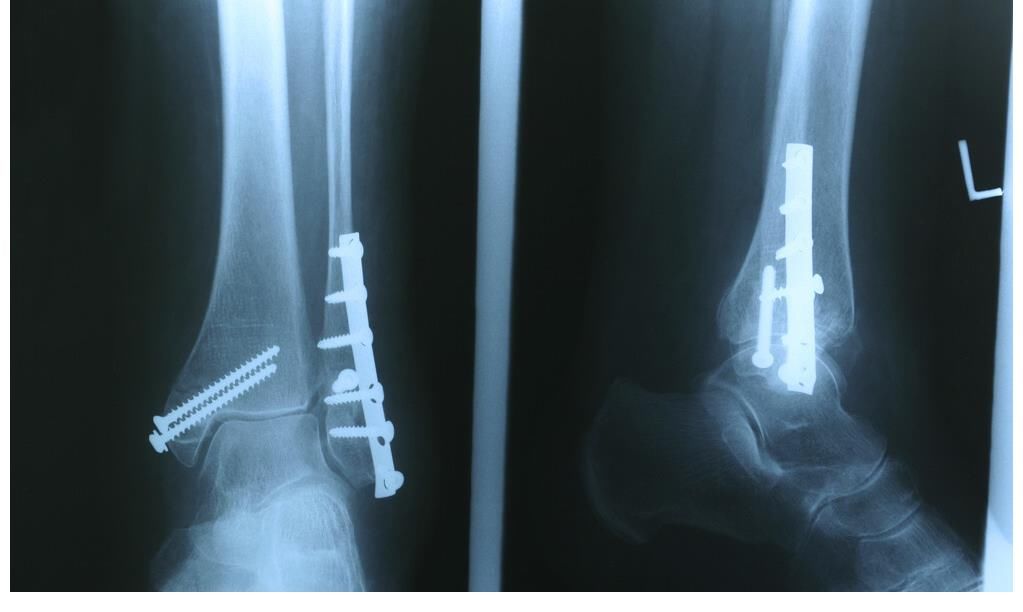 骨组织|骨科专家：预防骨质疏松，这几点请记好