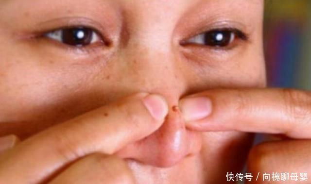 枕套|鼻子上总是挤出“白色条状物”学会这3招,和“草莓鼻”说拜拜