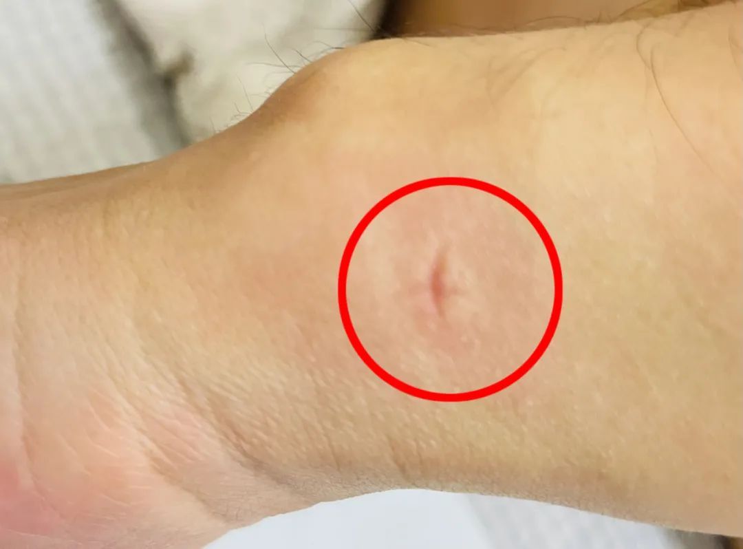 唾液|在蚊子包上涂口水、按“十”字，到底能不能止痒？