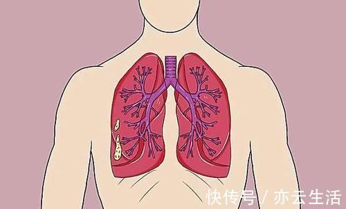 检查|肺部出现实性小结节,严重吗发生癌变的几率有多大