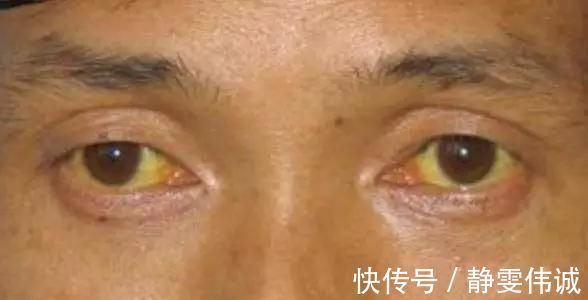 肝細胞|手掌出現的這個紋，居然是肝癌前兆肝臟發出的5個“求救”信號，別知道的太晚