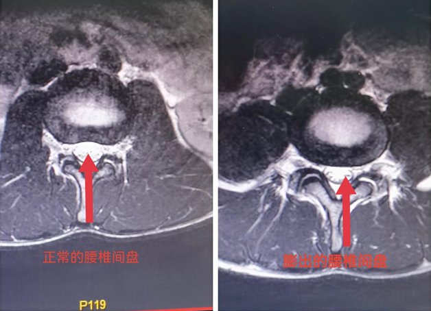 腰椎间盘突出症|一高三学生竟腰椎间盘突出！只因忽视了这件事