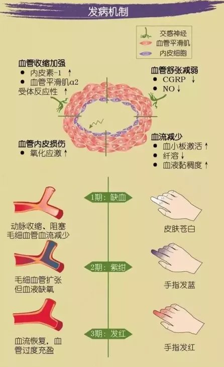 免疫病|年轻女子冻到手指苍白，专家提醒：可能是种免疫病