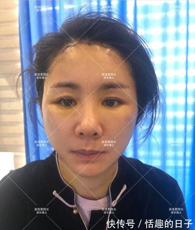 线雕 44岁小拉皮术后5个半月,用亲身经历谈一谈我的感受!
