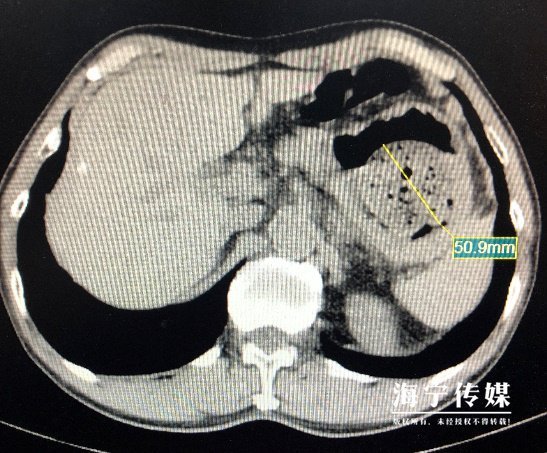 男子体内惊现金色“巨石”这水果不能多吃