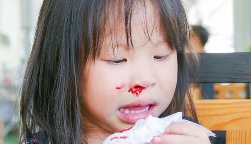 流鼻血后，要仰头、塞纸？别再错了，正确的处理方法记住这3点