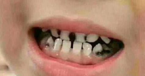 满嘴|4岁宝宝坚持刷牙,半年后却满嘴“小黑牙”,父母无知多可怕