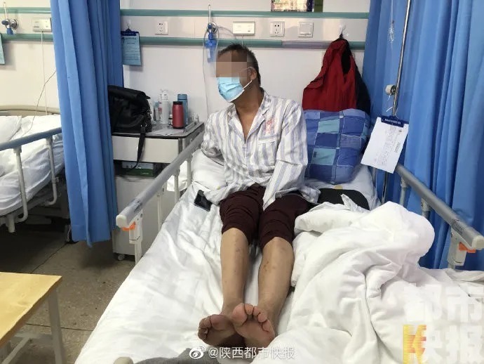 疼痛|咋回事?男子双腿突然冰凉疼痛难忍!医生:接近坏死的程度