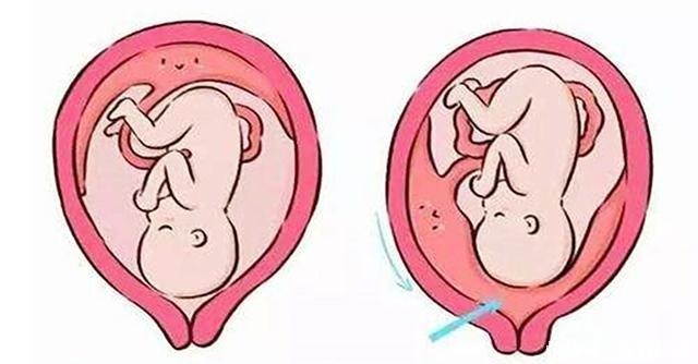前置|胎盘为什么会过低关于前置胎盘,孕妈不得不提前了解的知识