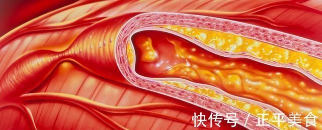 蛋黄|高血压患者谨记少吃2物,坚持2事,血压慢慢降回“安全线”