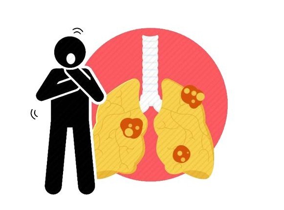 并发症|医生：肺癌手术不可怕，真正可怕的是这4种并发症，需小心护理！