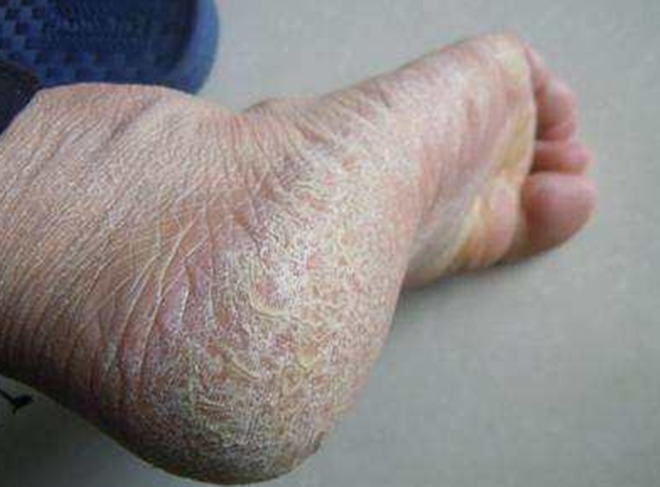 裂田|脚后跟的“裂田”,是因为缺水吗并非那么简单,劝你心里有个数