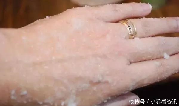 冬天手、耳朵、脚、腿又干又粗糙只需3步，让你皮肤又白又嫩