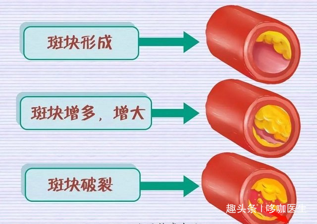 指标|引发心梗的高血脂,应该检查哪些指标