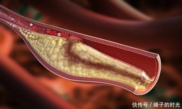 动作|血栓最怕这个动作,每天只需10秒,躺着就能做,助你远离血栓!