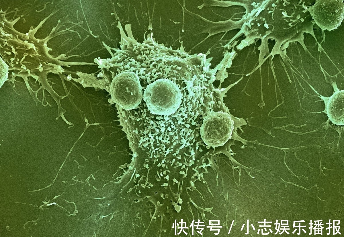 肿瘤细胞|晚期肺癌就要放弃治疗已经有很多病人从治疗中获益,可长期生存