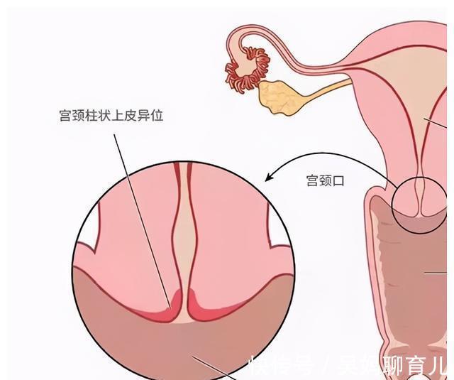 宫颈|提醒广大女性:一般情况下,3种“妇科病”不用治,别自己吓自己