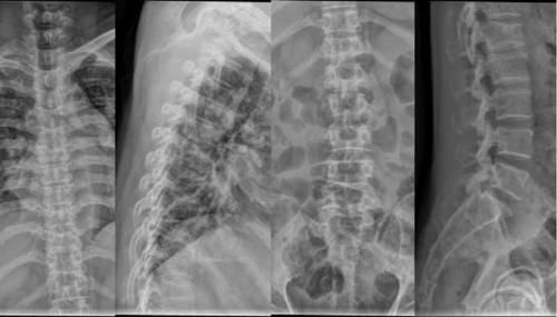 椎体|脊柱常见肿瘤及肿瘤样病变的几种影像学表现,你都见过吗?