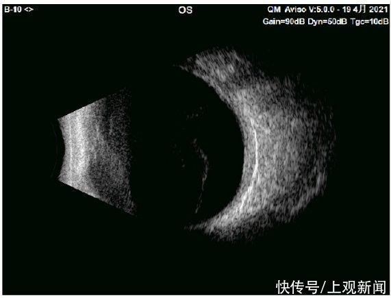 b超|眼外伤不可怕，重见光明有希望