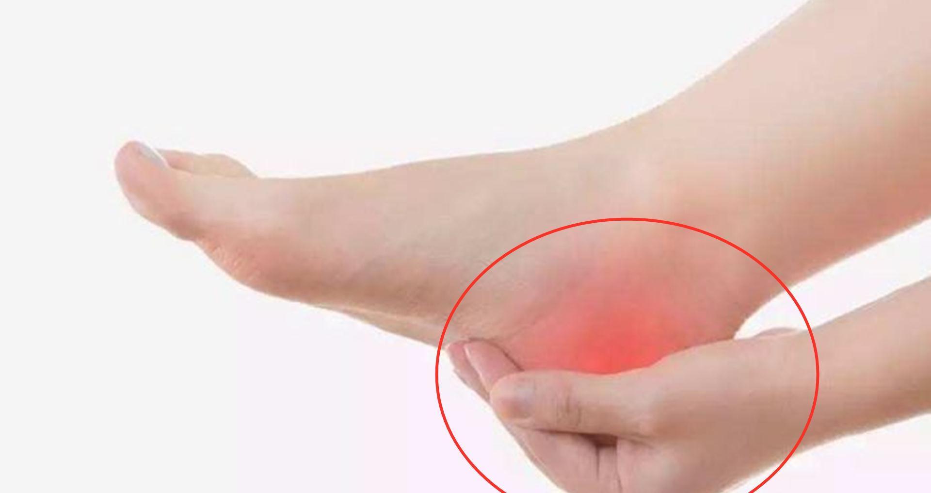 运动量|假如我们脚后跟痛,千万不要忍,可能与疾病相关